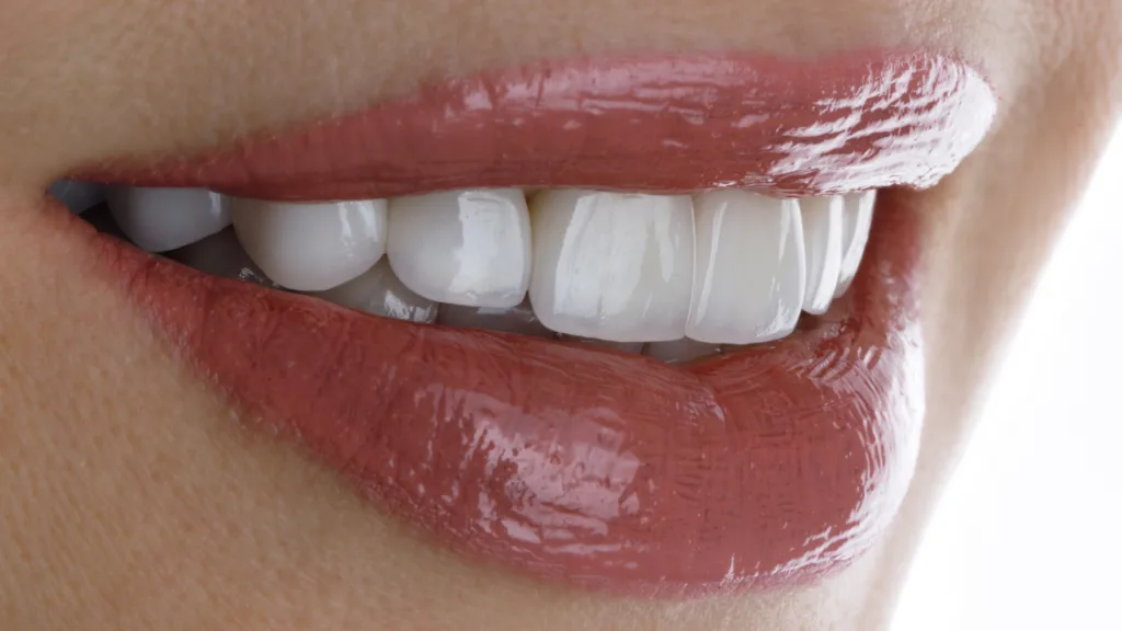 Come si mettono le faccette dentali | Studi WHITE Trento