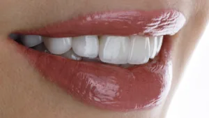 come si mettono le faccette dentali