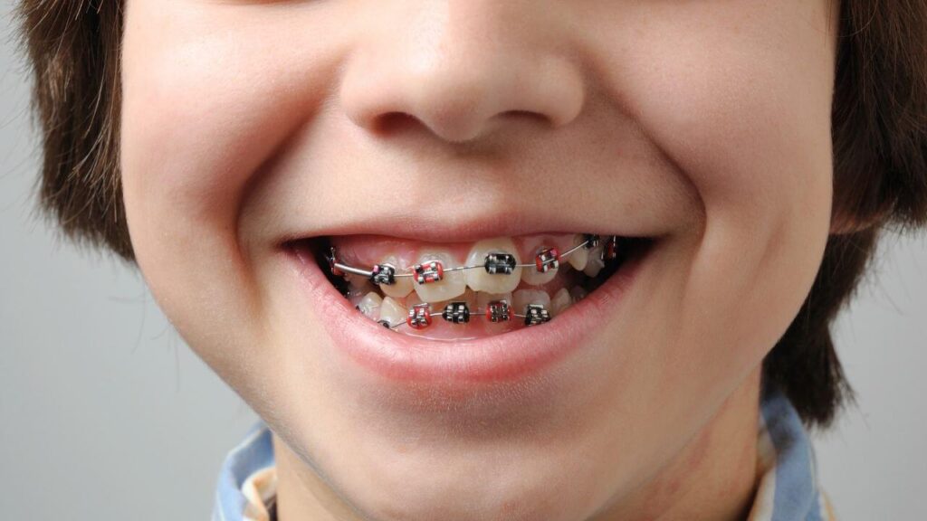 Ortodonzia tradizionale: riallineare i denti con l’apparecchio metallico 3 apparecchio denti trento dentista