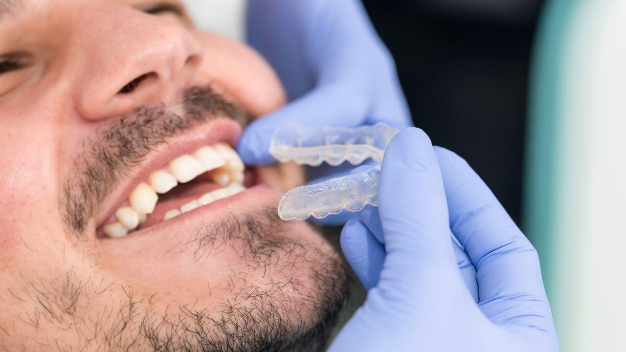 Ottenere denti dritti grazie ad un allineatore trasparente? Nel nostro Studio è possibile! 1 invisalign trento