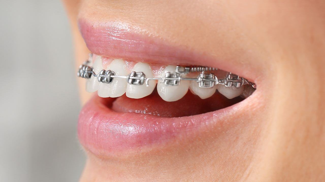 Ortodonzia tradizionale: riallineare i denti con l’apparecchio metallico 1 dentista apparecchio denti trento
