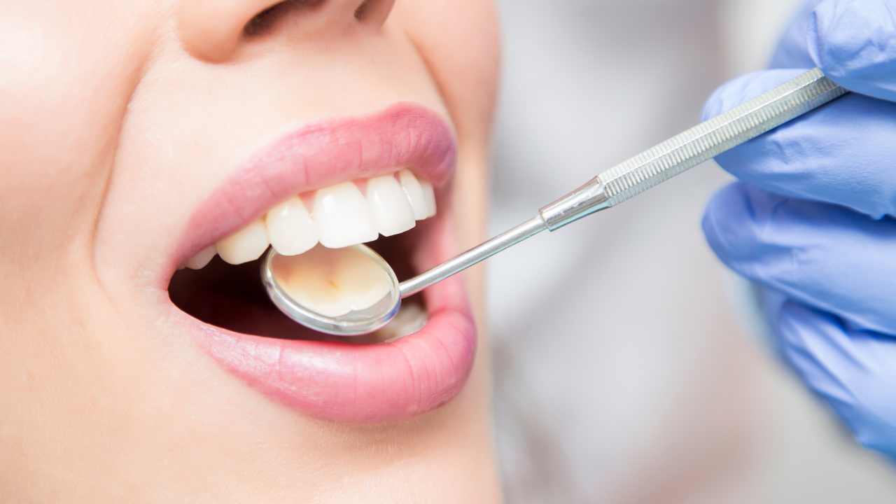 faccette e corone dentali