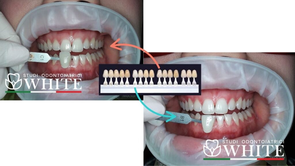 sbiancamento express studi odontoiatrici white trento