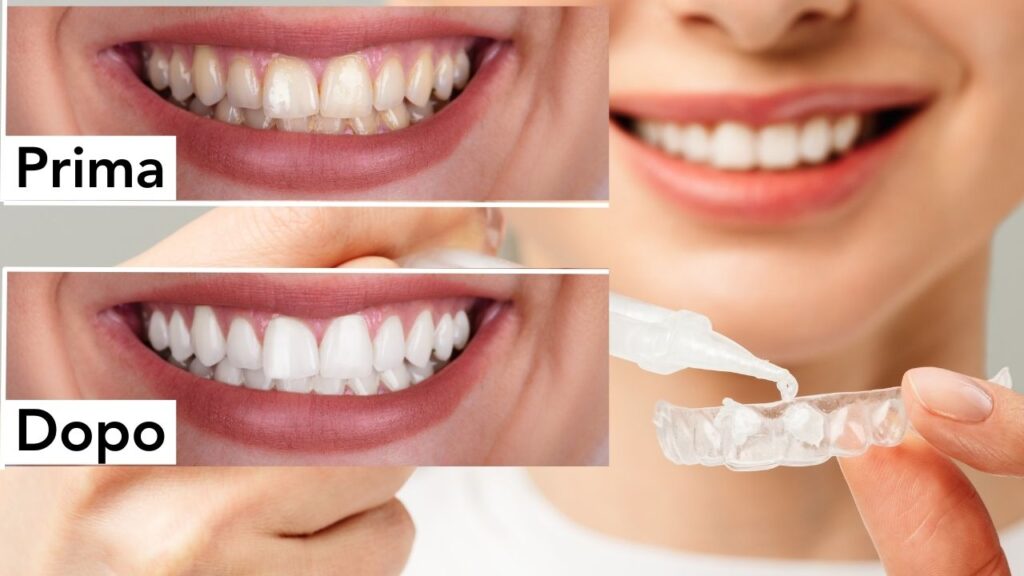 sbiancamento denti trento dentista