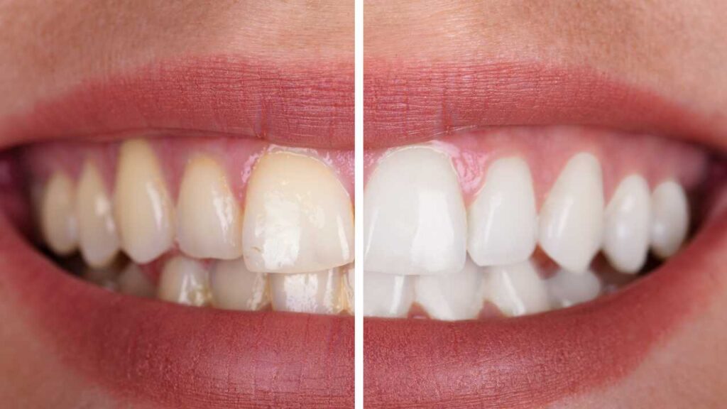 sbiancamento denti trento dentista