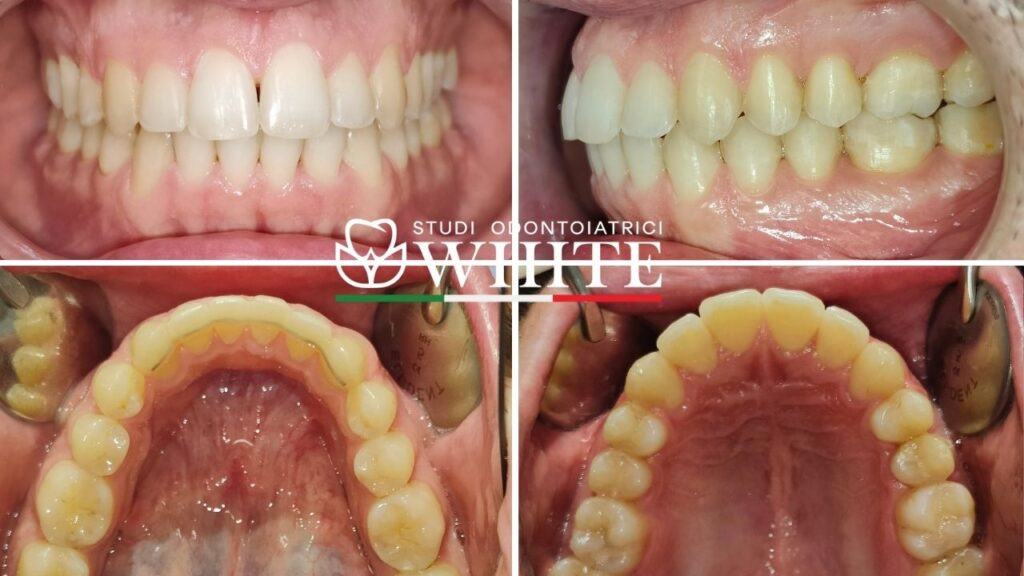 dentista apparecchio denti trento invisalign