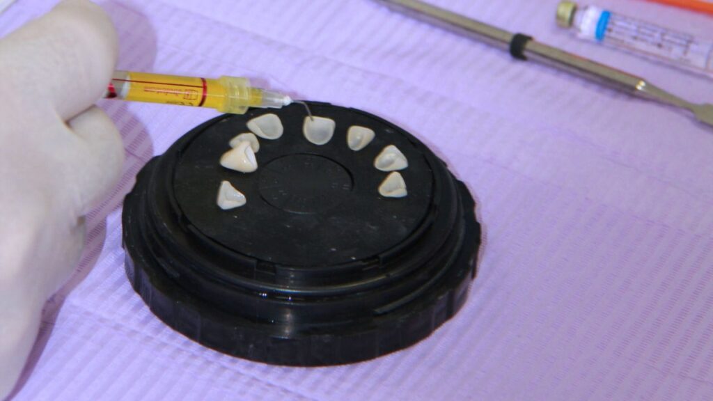 faccette e corone in ceramica trento 1