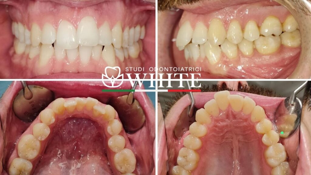 invisalign allineatori trasparenti