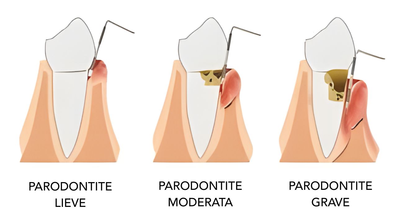 PARODONTITE PIORREA CURA DENTISTA TRENTO CAUSE RIMEDI
