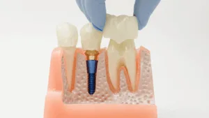 Posizionamento della corona dentale sul modello implantare nella mascella