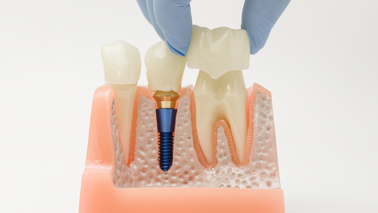 Posizionamento della corona dentale sul modello implantare nella mascella