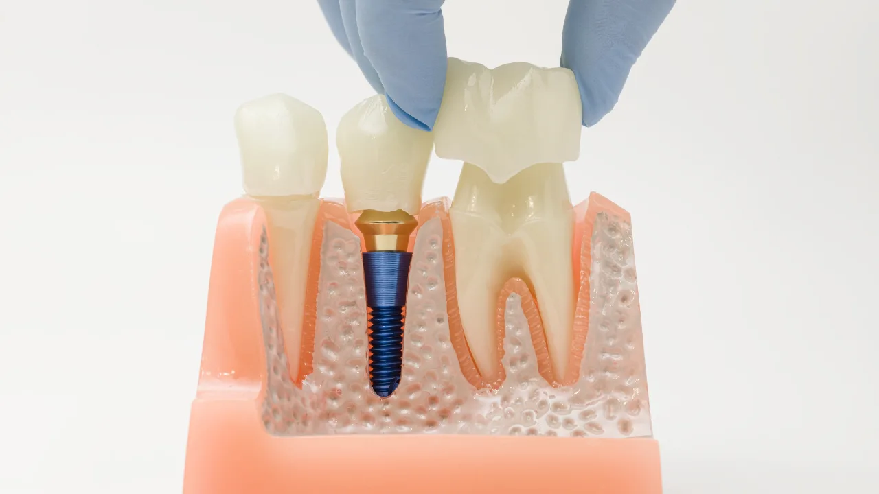 Posizionamento della corona dentale sul modello implantare nella mascella