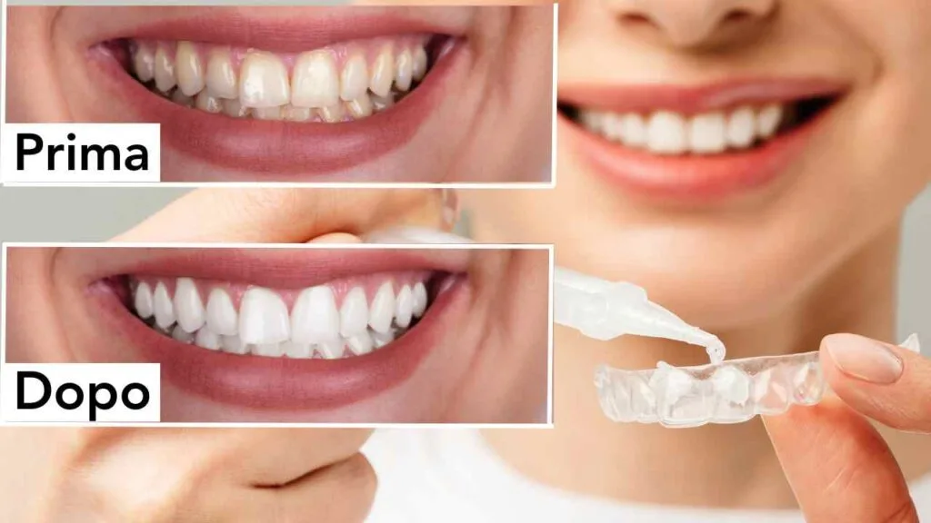 sbiancamento denti trento dentista