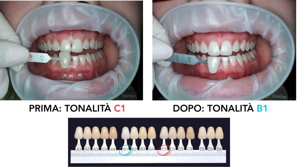 sbiancamento express prima dell'igiene dentale presso studi white trento_click
