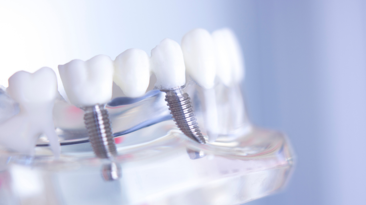 Meglio dentiera o impianto dentale - osteointegrazione Studi White Trento
