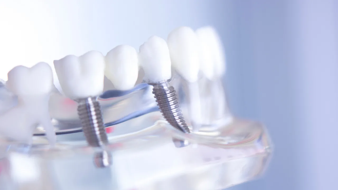 Meglio dentiera o impianto dentale - osteointegrazione Studi White Trento