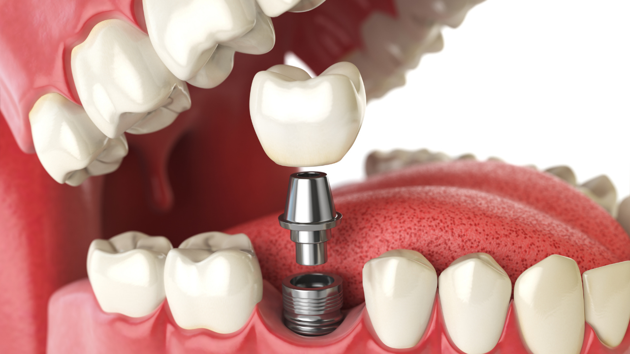 Protesi su impianti: alternativa a meglio dentiera o impianto - Studi White