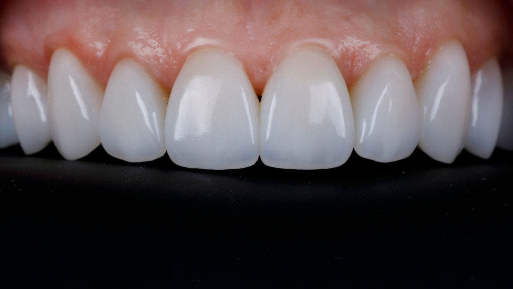 Implantologia Arcata Superiore: Guida Completa | Studi WHITE