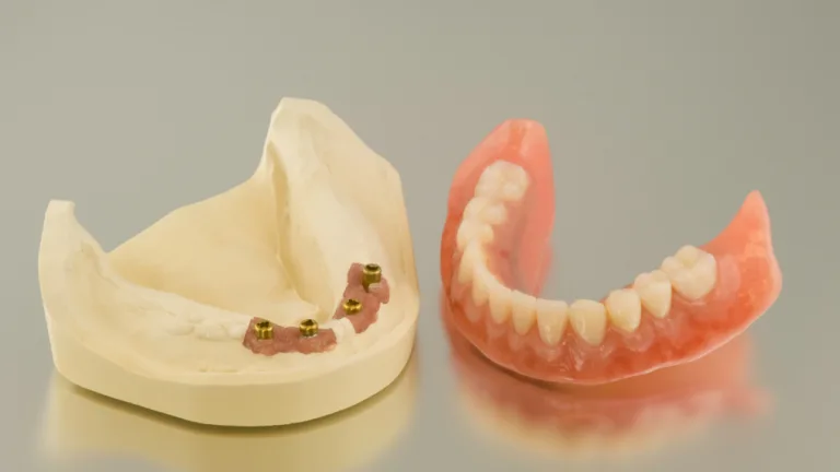 meglio dentiera o impianto