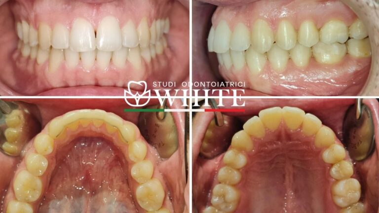 dentista apparecchio denti trento invisalign
