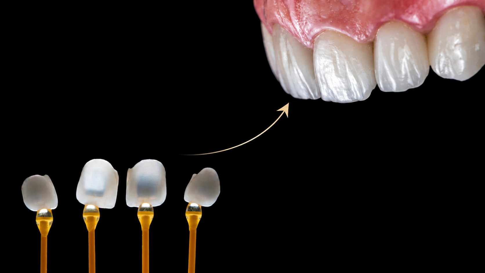 come si mettono le faccette dentali in ceramica - Studi WHITE Trento