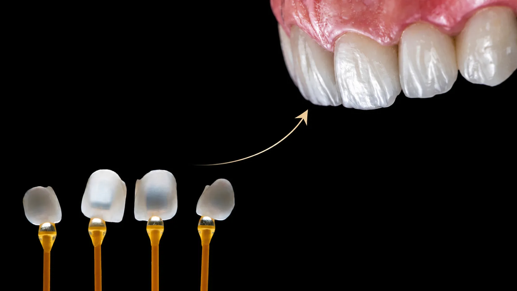 come si mettono le faccette dentali in ceramica - Studi WHITE Trento