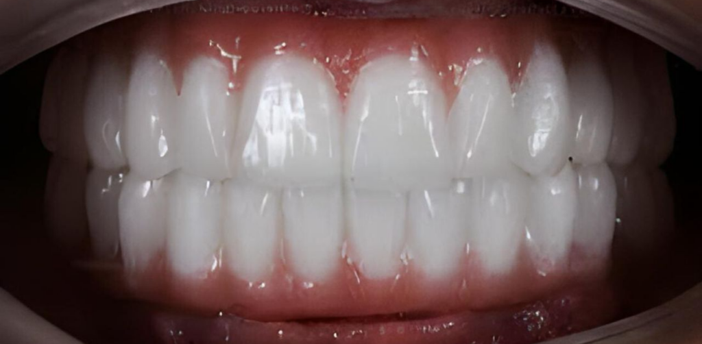 Materiali Dentali all’Avanguardia: Scopri le Soluzioni per Impianti Duraturi e Sicuri a Trento 4 denti fissi zirconio dentista impianti