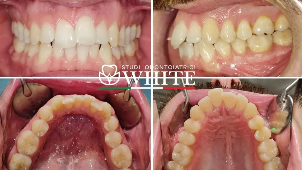invisalign allineatori trasparenti