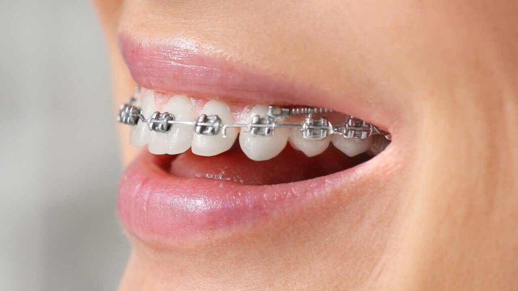 Dentista a Trento: Come Scegliere il Professionista Giusto per le Tue Esigenze 6 ortodonzia trento apparecchio