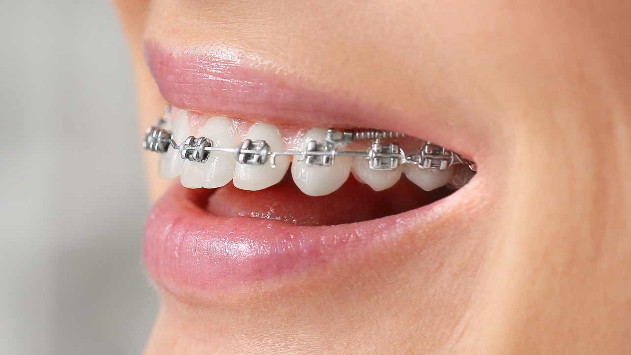apparecchio denti trento
