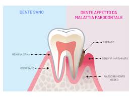 parodontite cura dentista atrento