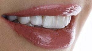 sbiancamento dentale_