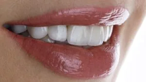 sbiancamento dentale_