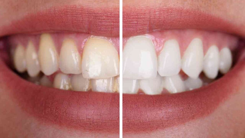 Dentista a Trento: Come Scegliere il Professionista Giusto per le Tue Esigenze 4 sbiancamento denti