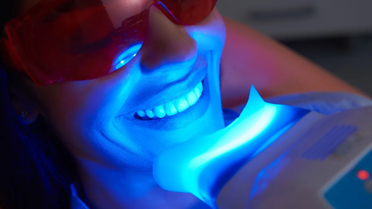 sbiancamento denti professionale