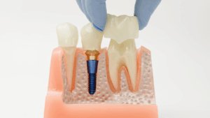 Posizionamento della corona dentale sul modello implantare nella mascella
