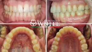 dentista apparecchio denti trento invisalign