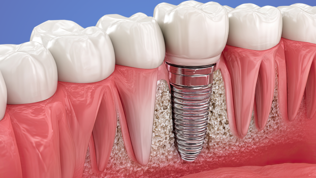 Impianti Osteointegrati: Cosa Sono e Cosa Aspettarsi